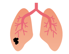 肺がん